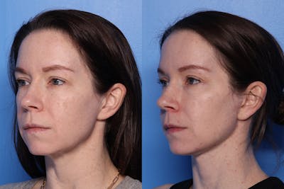 Neck Lift Before & After Gallery - Patient 418318 - Image 1