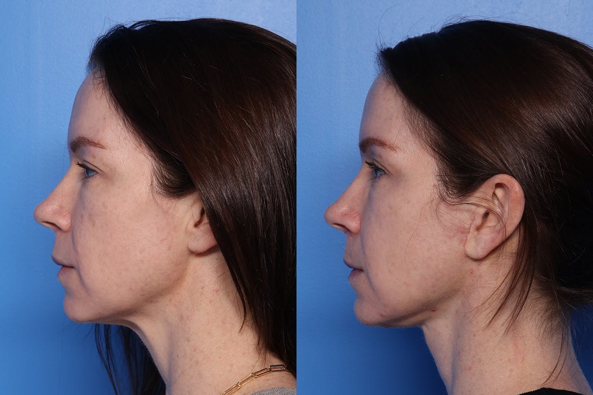 Neck Lift Before & After Gallery - Patient 418318 - Image 6