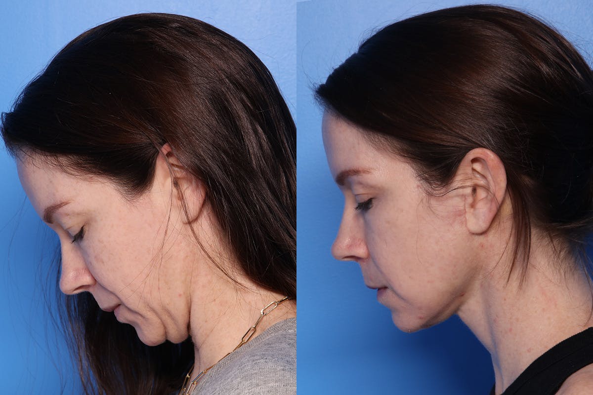 Neck Lift Before & After Gallery - Patient 418318 - Image 7