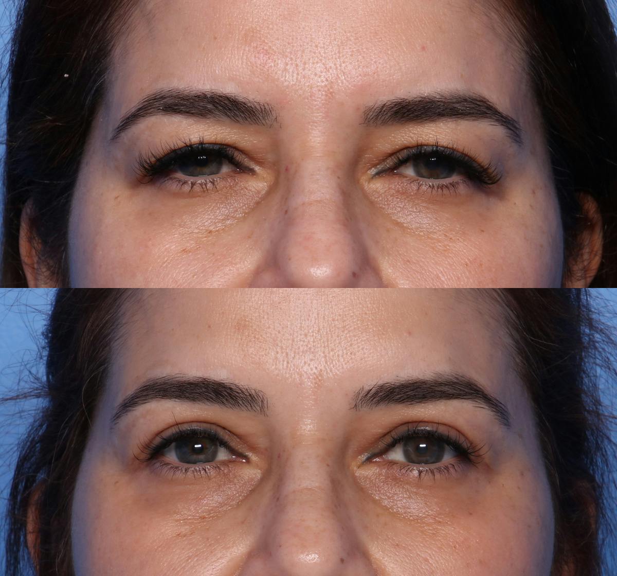 Blepharoplasty Before & After Gallery - Patient 427042 - Image 1