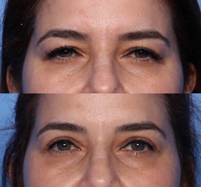 Blepharoplasty Before & After Gallery - Patient 427042 - Image 1
