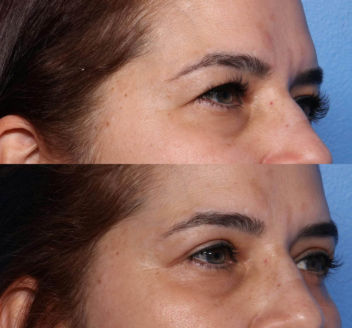 Blepharoplasty Before & After Gallery - Patient 427042 - Image 2