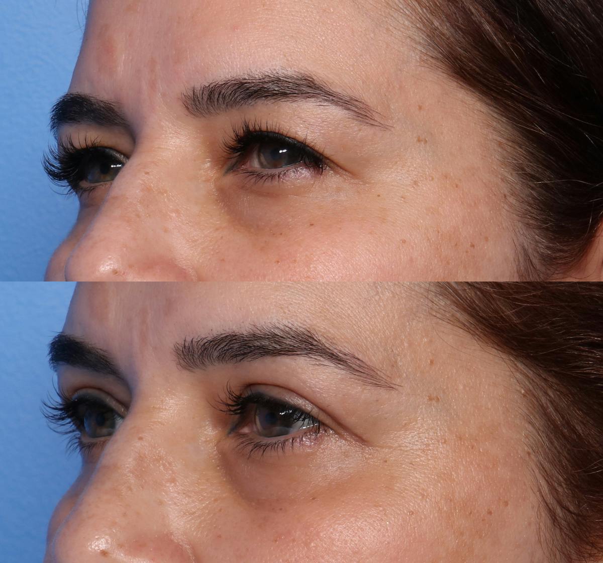 Blepharoplasty Before & After Gallery - Patient 427042 - Image 3
