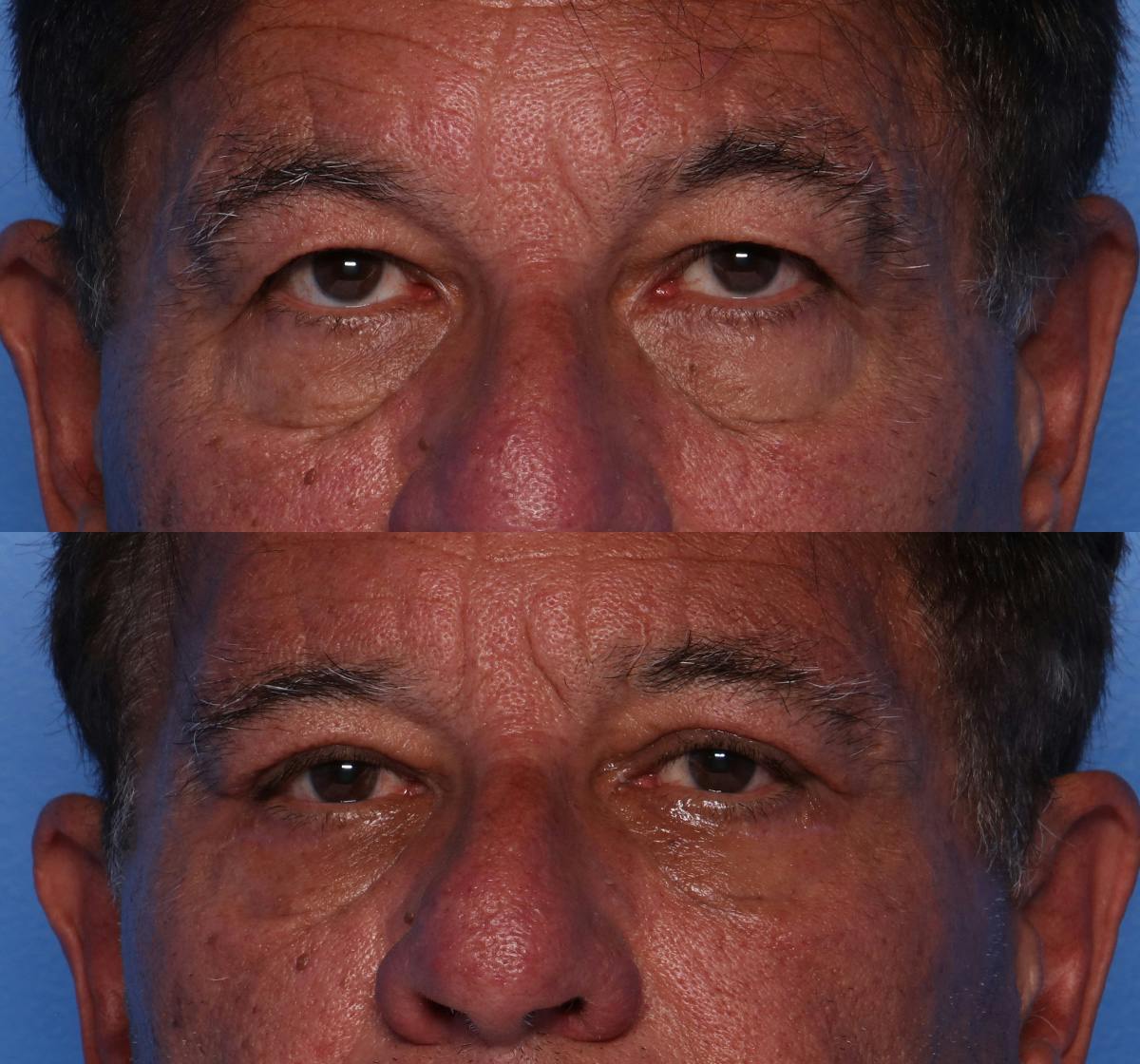 Brow Lift Before & After Gallery - Patient 349271 - Image 1