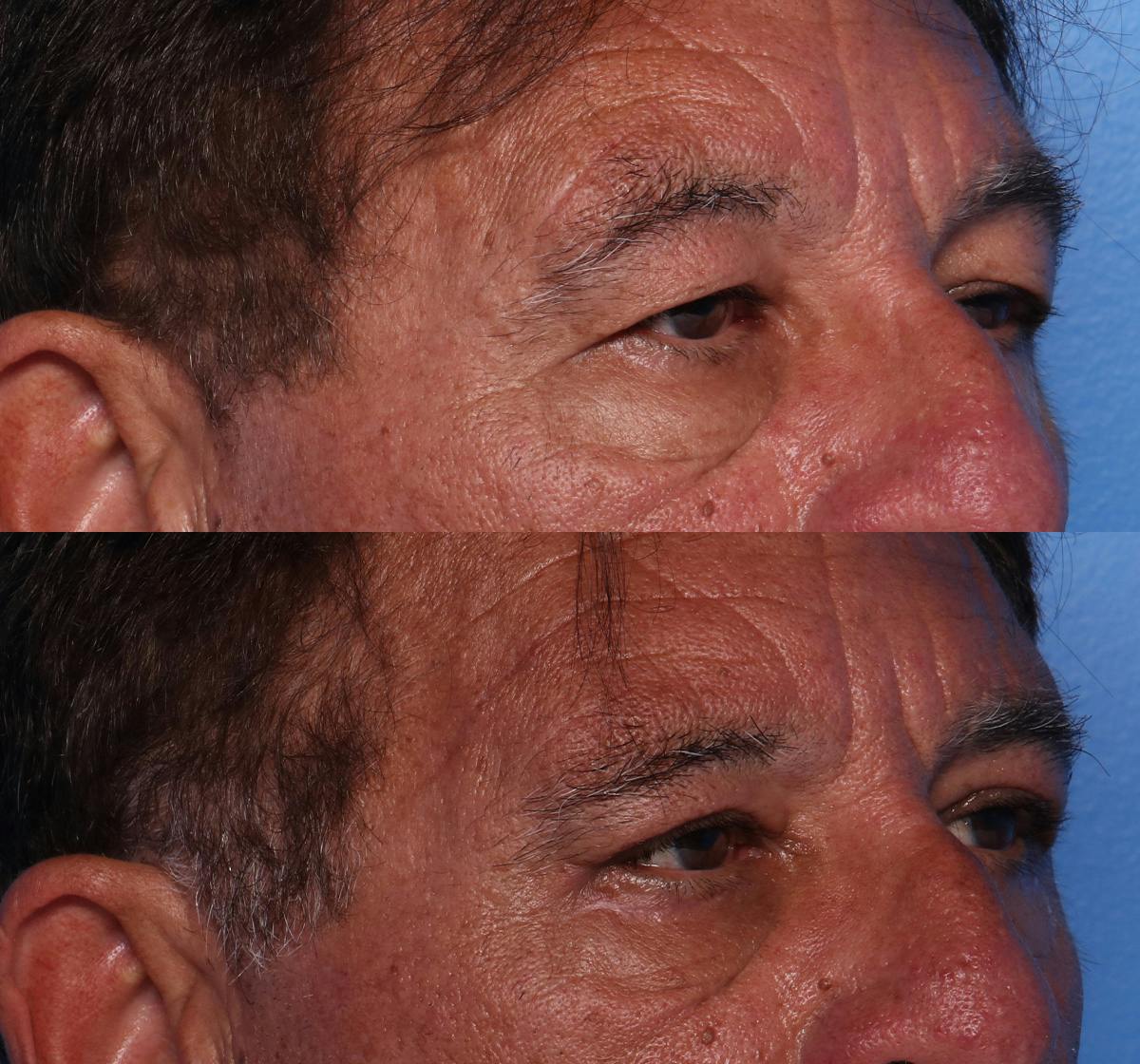 Brow Lift Before & After Gallery - Patient 349271 - Image 2