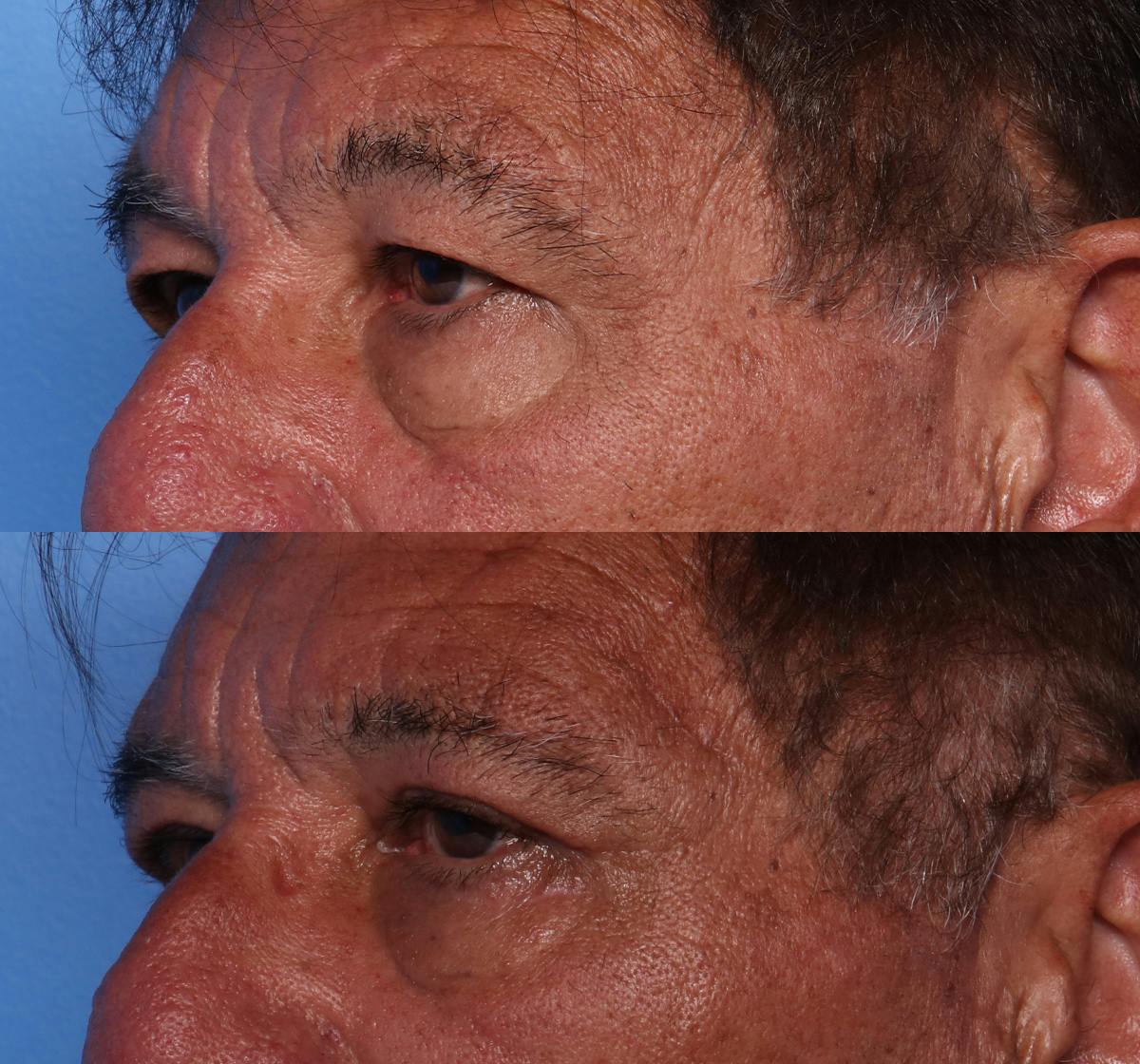 Brow Lift Before & After Gallery - Patient 349271 - Image 3