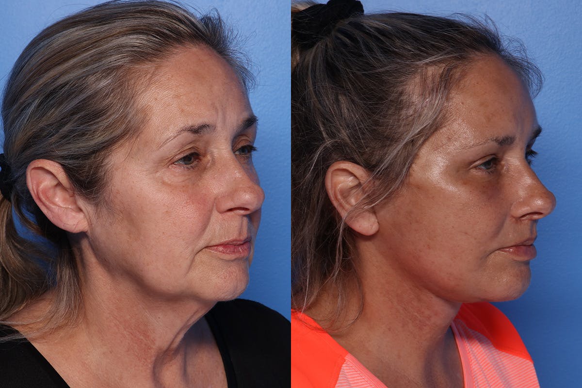 Lip Lift Before & After Gallery - Patient 429325 - Image 2