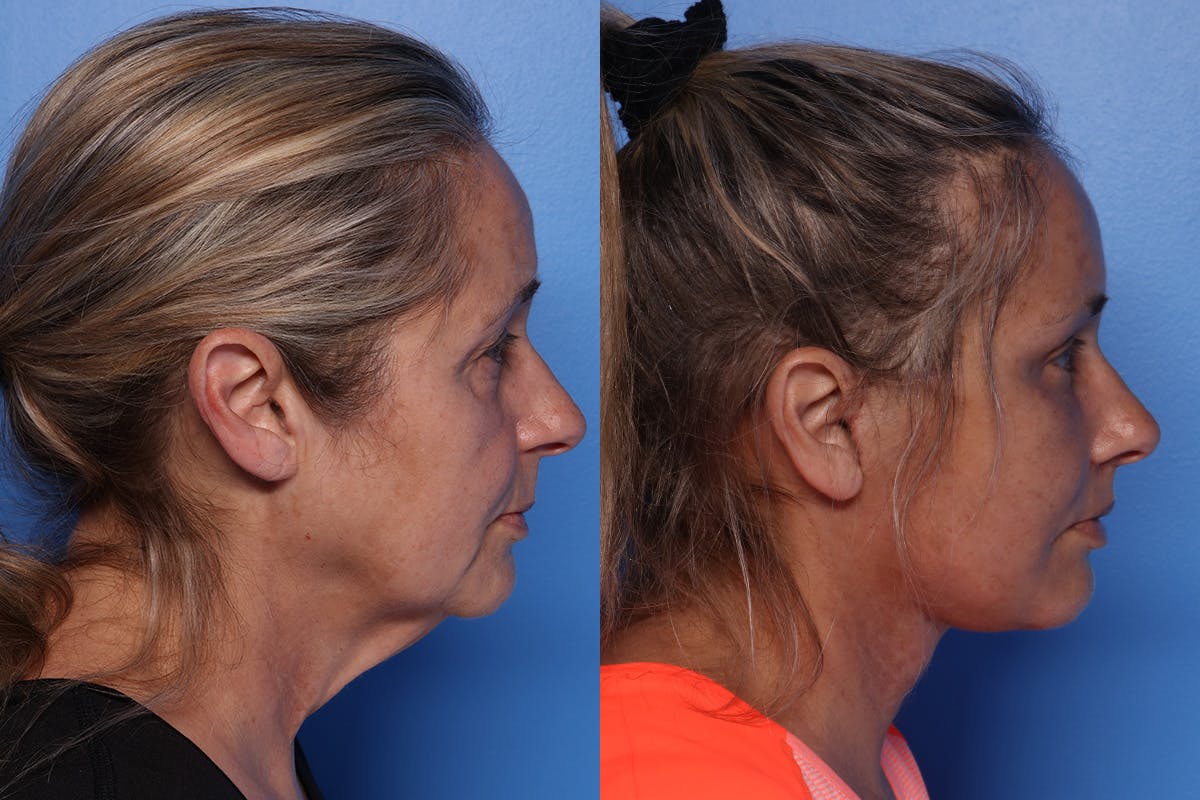 Lip Lift Before & After Gallery - Patient 429325 - Image 3