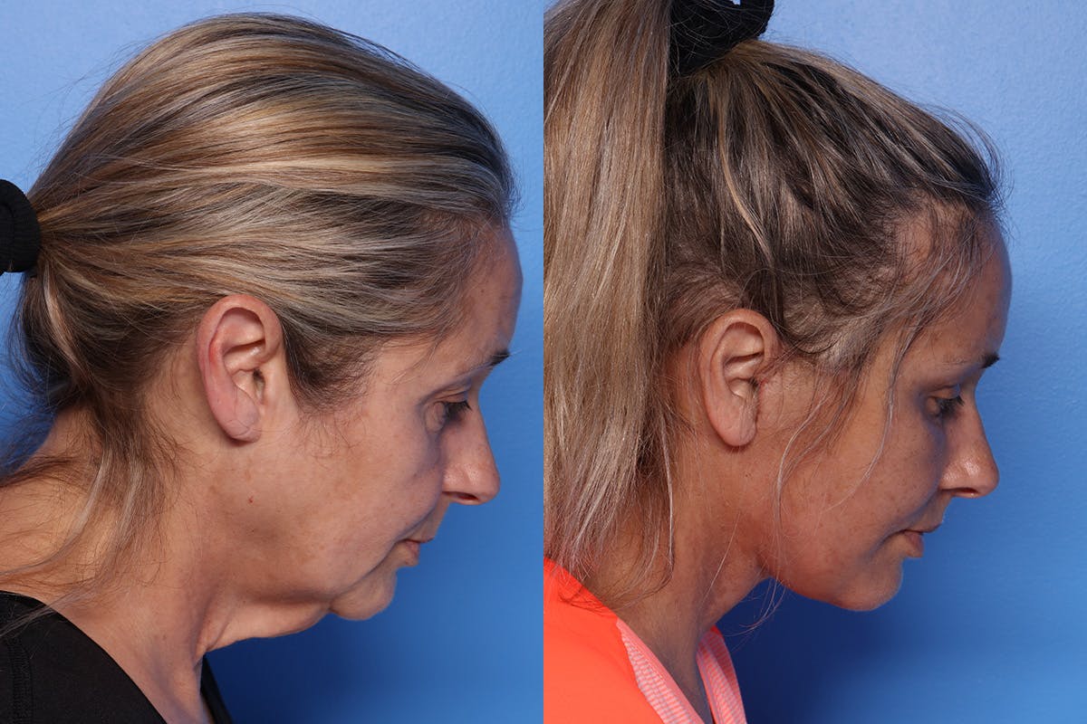 Lip Lift Before & After Gallery - Patient 429325 - Image 4