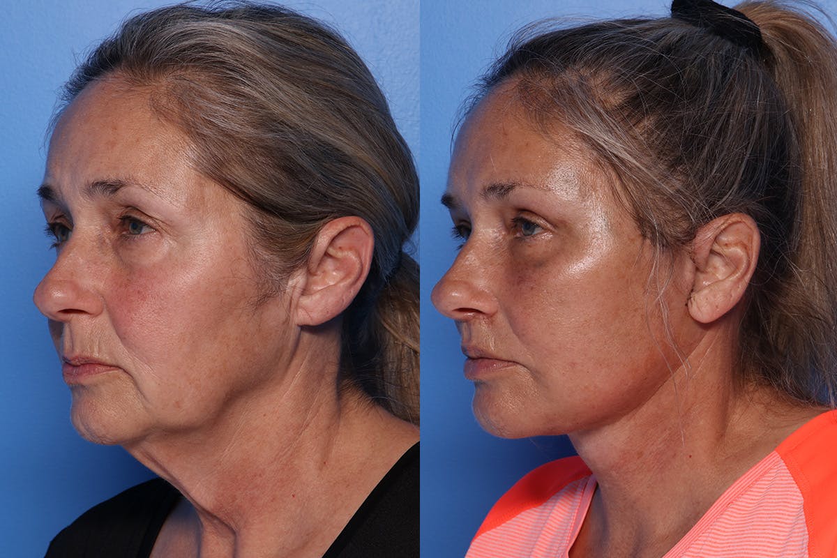 Lip Lift Before & After Gallery - Patient 429325 - Image 5