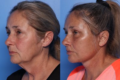 Neck Lift Before & After Gallery - Patient 511964 - Image 1