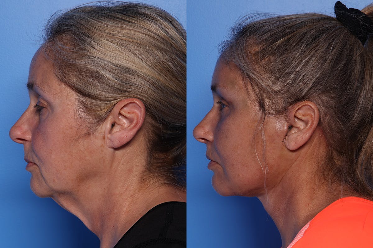Lip Lift Before & After Gallery - Patient 429325 - Image 6