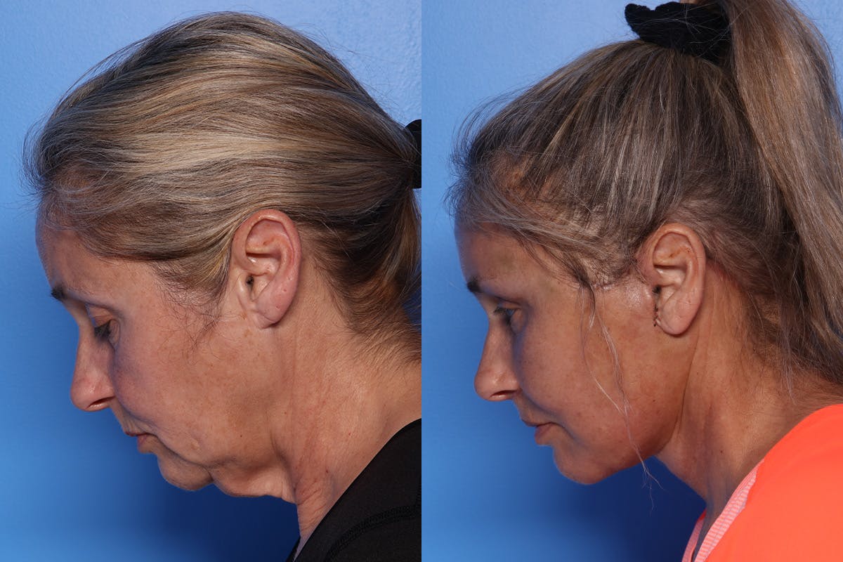 Lip Lift Before & After Gallery - Patient 429325 - Image 7