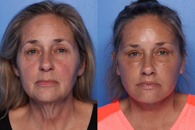 Fat Grafting Before & After Gallery - Patient 202341 - Image 1