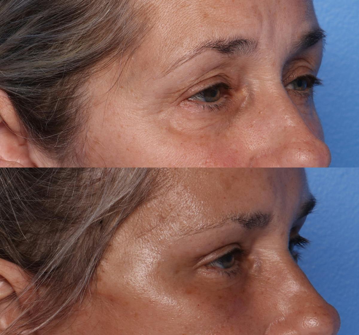 Blepharoplasty Before & After Gallery - Patient 226329 - Image 2