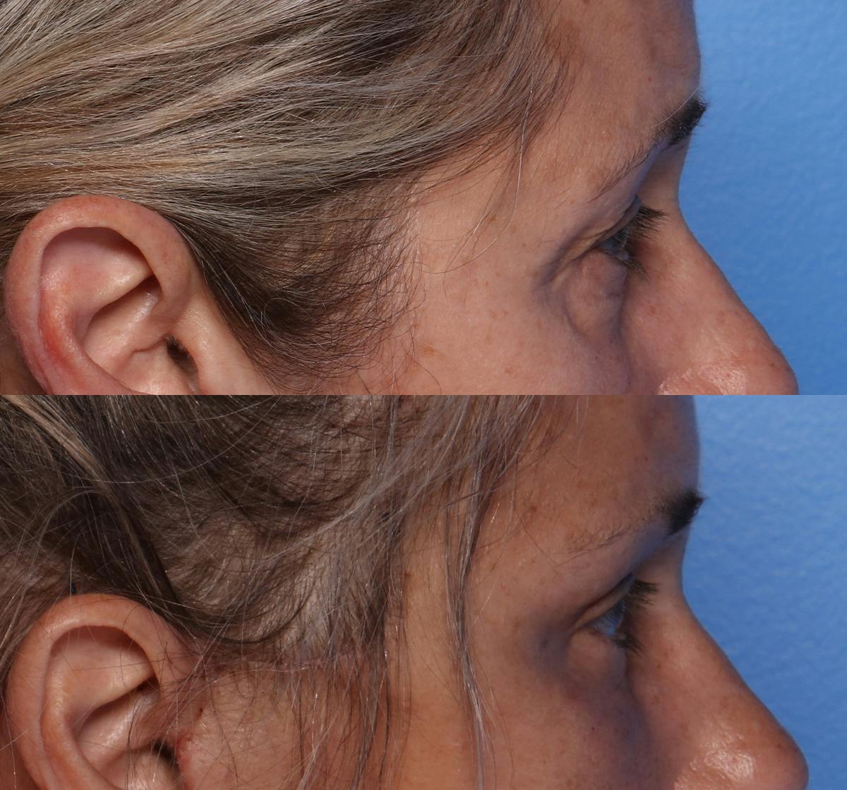 Blepharoplasty Before & After Gallery - Patient 226329 - Image 3