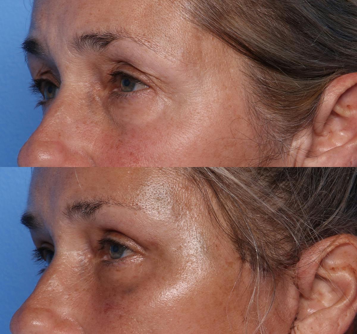 Blepharoplasty Before & After Gallery - Patient 226329 - Image 4