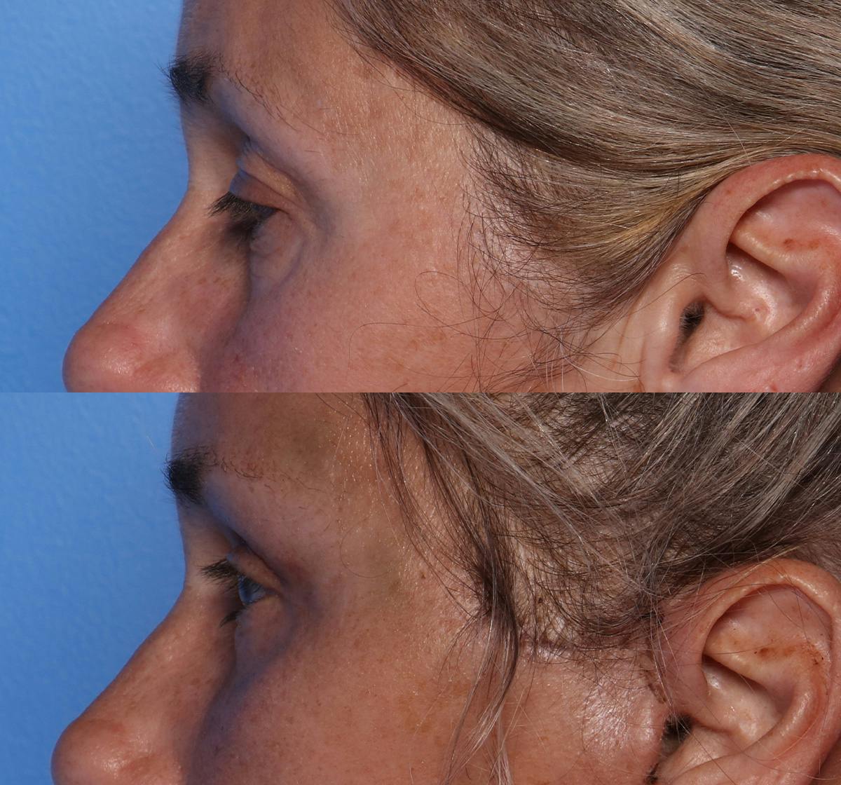 Blepharoplasty Before & After Gallery - Patient 226329 - Image 5