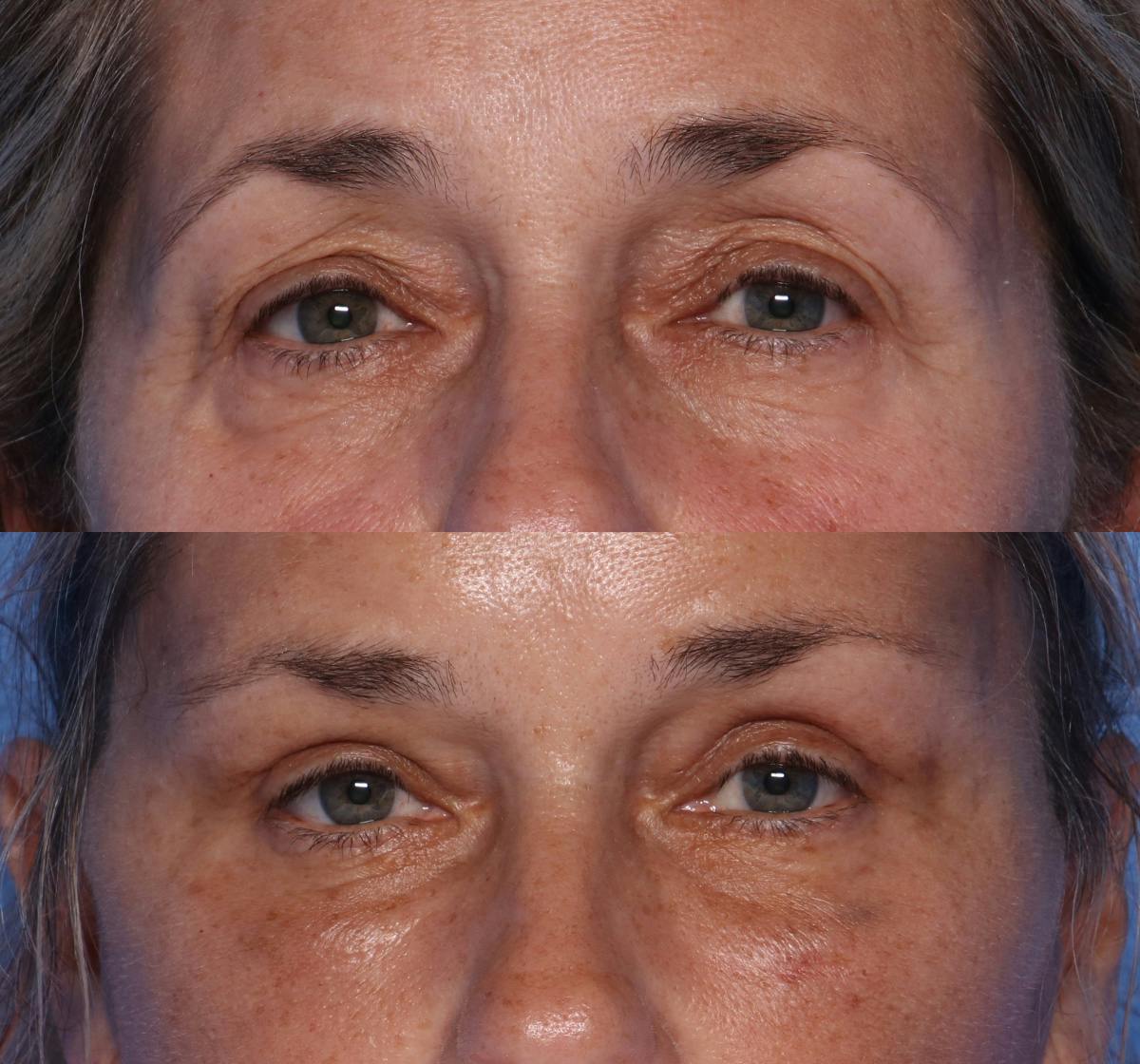 Blepharoplasty Before & After Gallery - Patient 226329 - Image 1