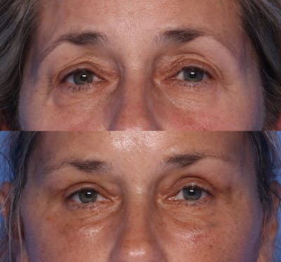 Blepharoplasty Before & After Gallery - Patient 226329 - Image 1
