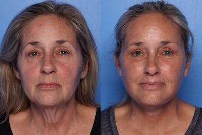Facelift Before & After Gallery - Patient 709048 - Image 1