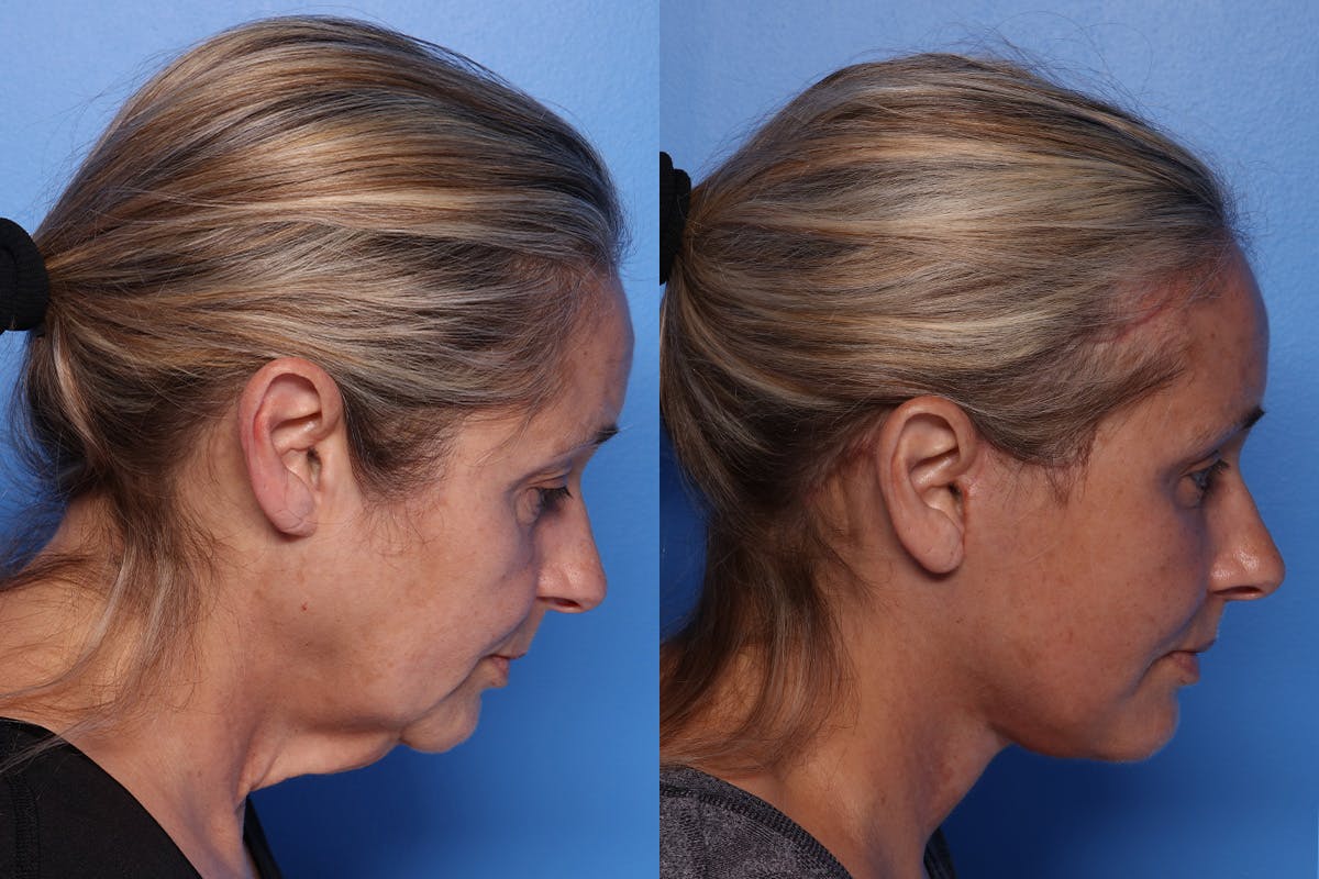 Facelift Before & After Gallery - Patient 709048 - Image 4