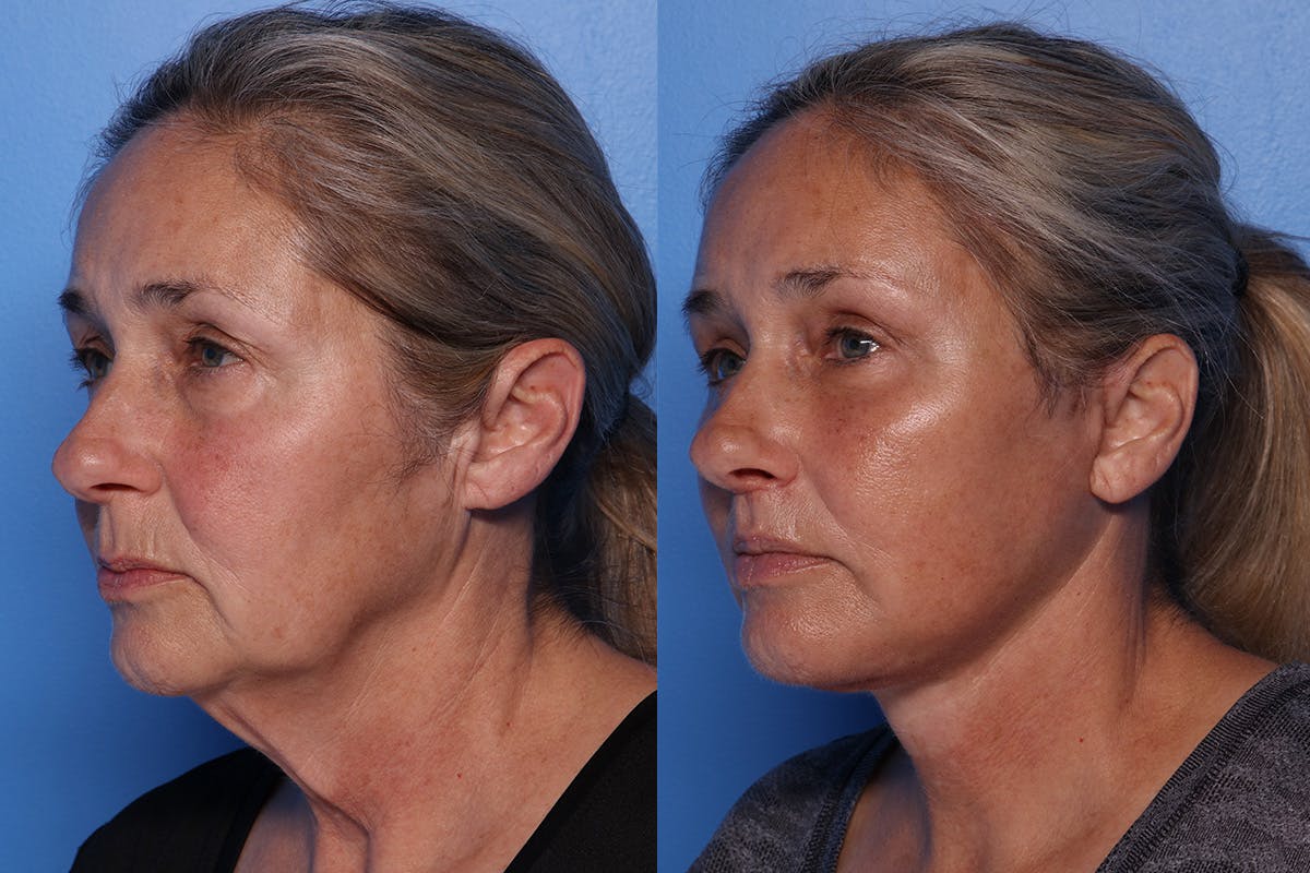 Facelift Before & After Gallery - Patient 709048 - Image 5