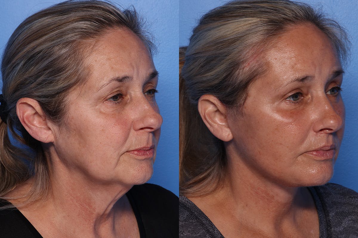 Facelift Before & After Gallery - Patient 709048 - Image 2