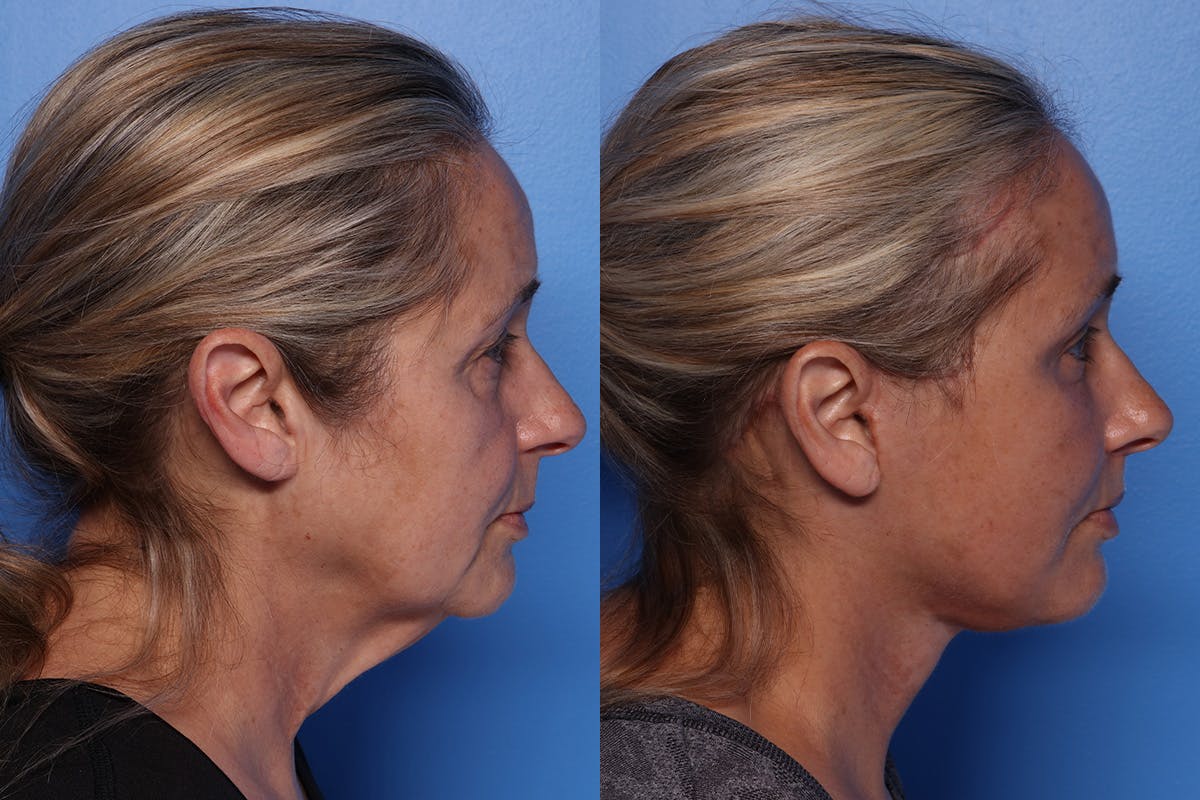 Facelift Before & After Gallery - Patient 709048 - Image 3