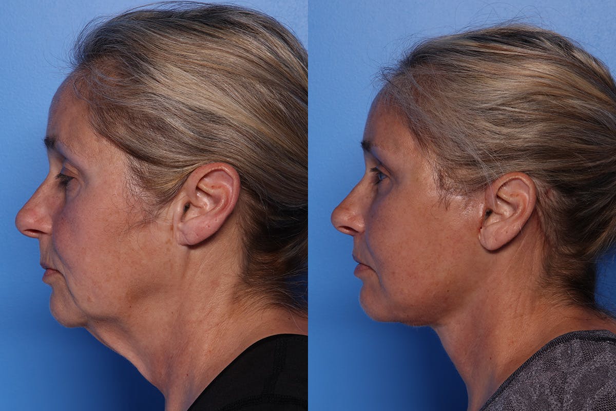 Facelift Before & After Gallery - Patient 709048 - Image 6