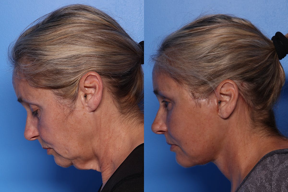 Facelift Before & After Gallery - Patient 709048 - Image 7