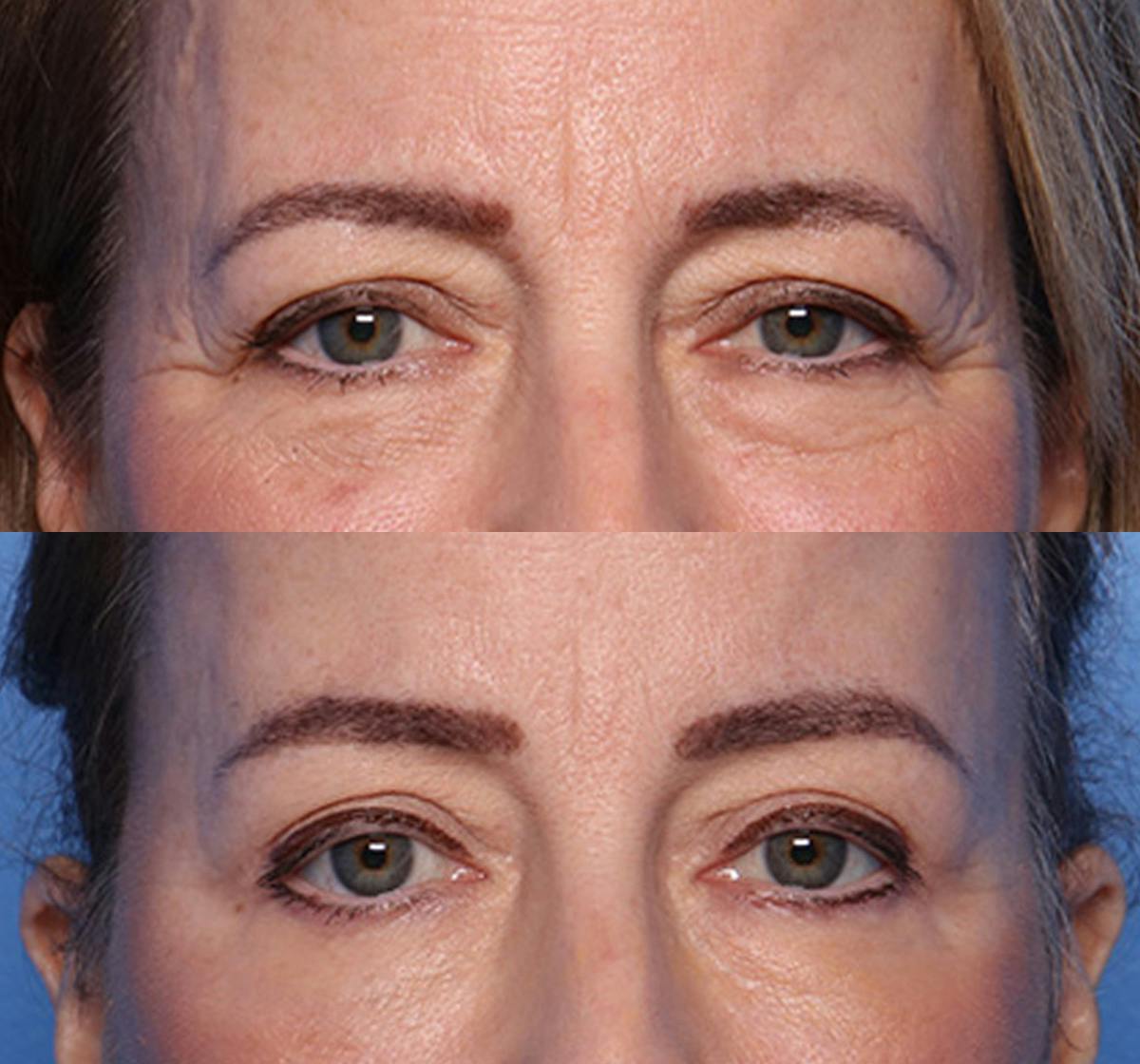 Blepharoplasty Before & After Gallery - Patient 143600 - Image 1
