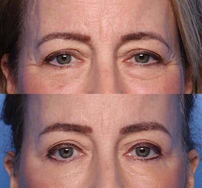 Blepharoplasty Before & After Gallery - Patient 143600 - Image 1