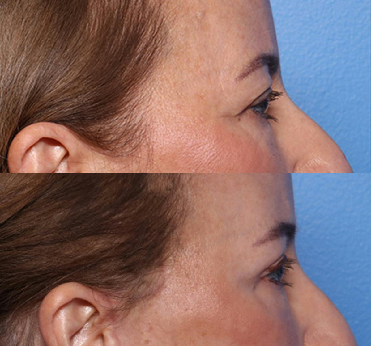 Blepharoplasty Before & After Gallery - Patient 143600 - Image 2