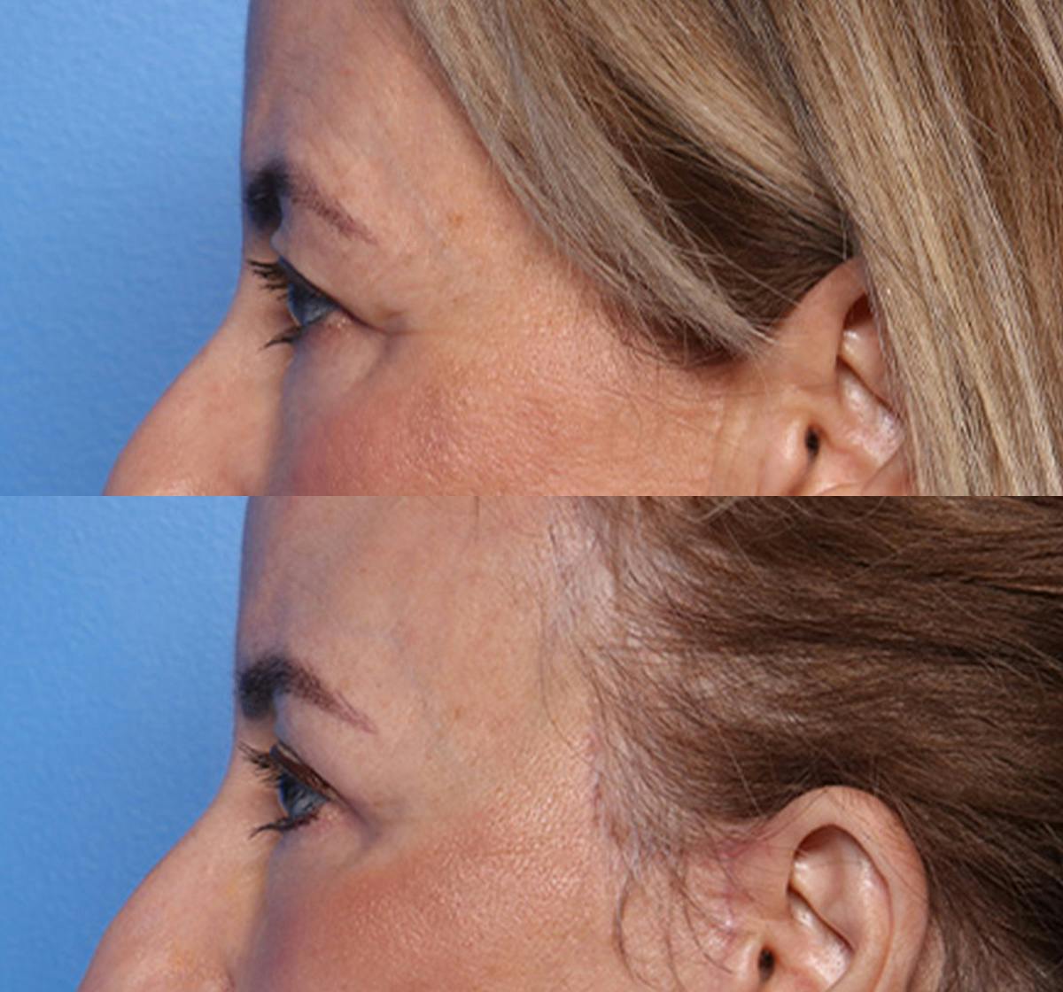 Blepharoplasty Before & After Gallery - Patient 143600 - Image 3