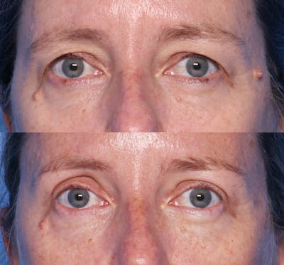 Blepharoplasty Before & After Gallery - Patient 140543 - Image 1