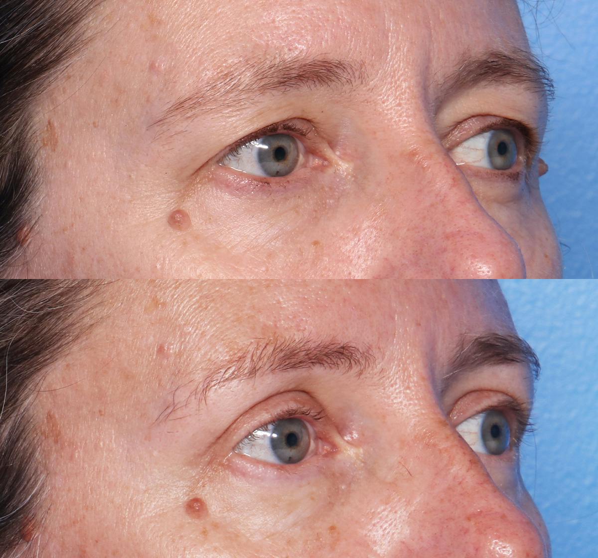 Blepharoplasty Before & After Gallery - Patient 140543 - Image 2