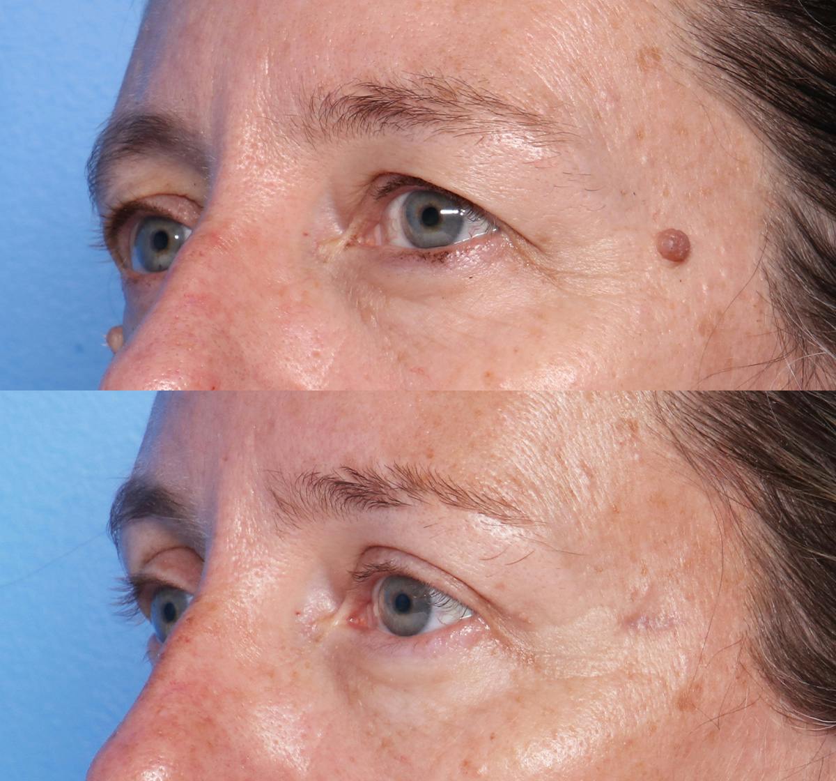 Blepharoplasty Before & After Gallery - Patient 140543 - Image 3