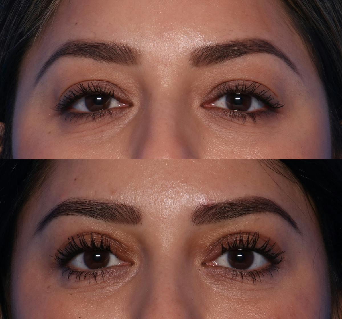 Blepharoplasty Before & After Gallery - Patient 109930 - Image 1