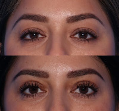 Blepharoplasty Before & After Gallery - Patient 109930 - Image 1