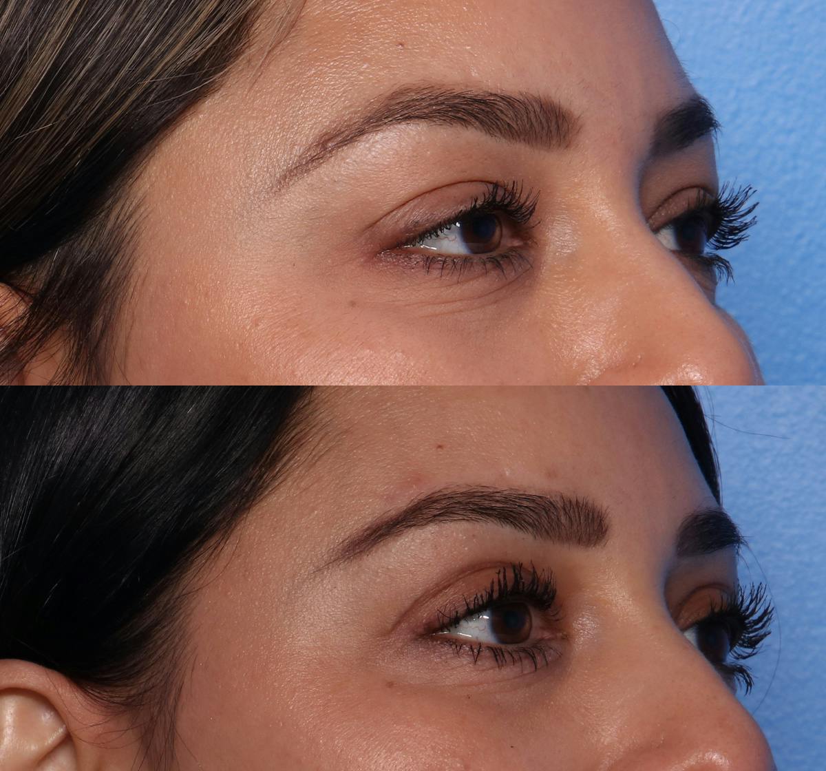 Blepharoplasty Before & After Gallery - Patient 109930 - Image 2