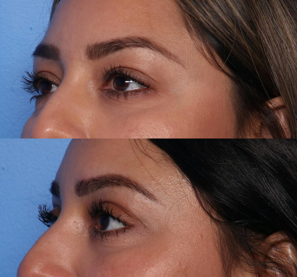 Blepharoplasty Before & After Gallery - Patient 109930 - Image 3