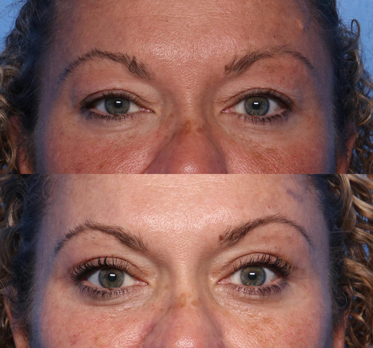 Blepharoplasty Before & After Gallery - Patient 286769 - Image 1