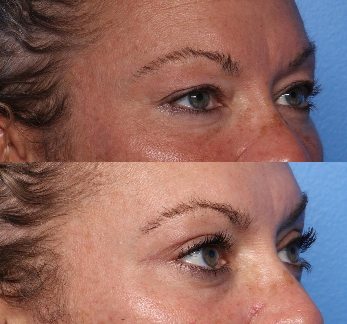 Blepharoplasty Before & After Gallery - Patient 286769 - Image 2