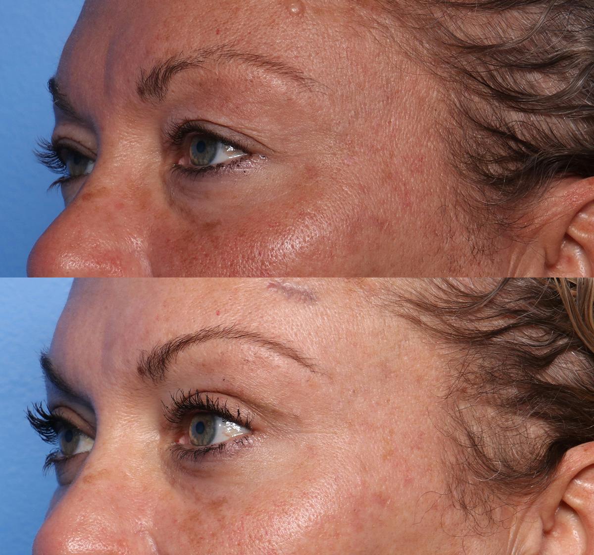 Blepharoplasty Before & After Gallery - Patient 286769 - Image 3
