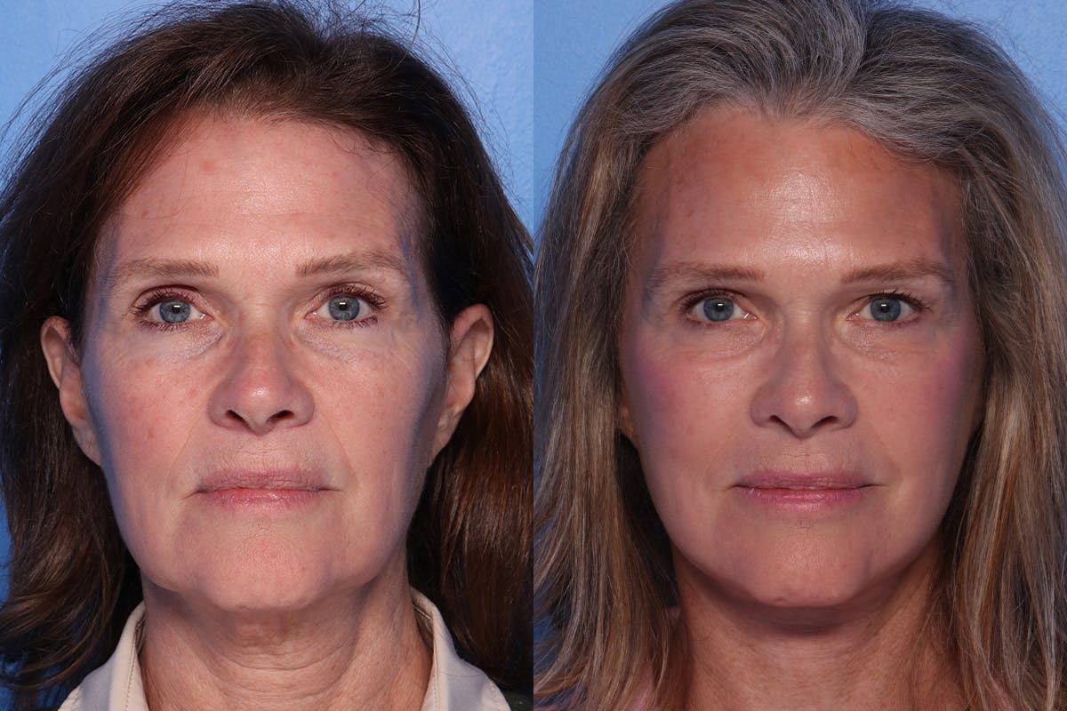 Facelift Before & After Gallery - Patient 342541 - Image 1