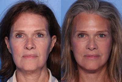 Facelift Before & After Gallery - Patient 342541 - Image 1