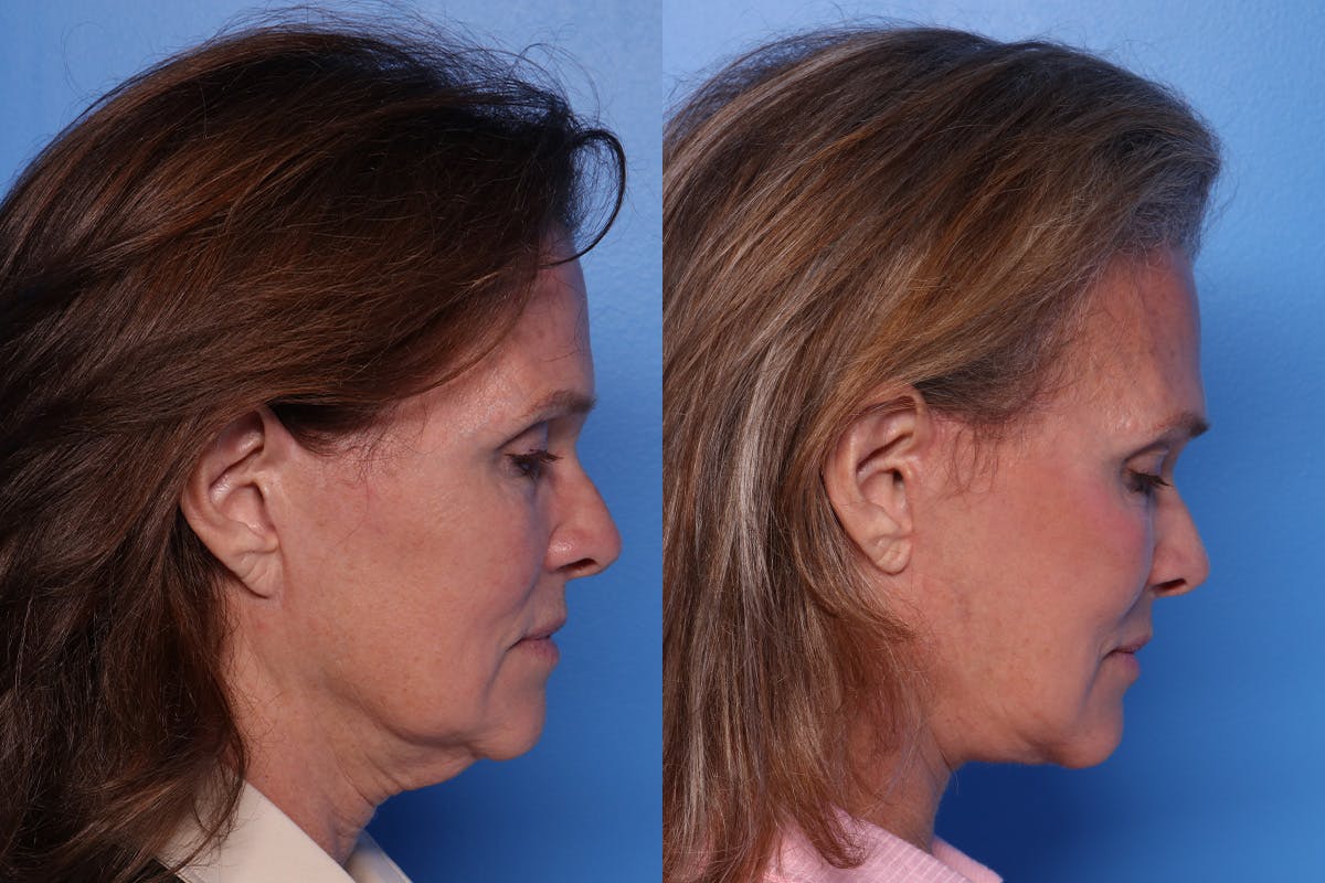 Facelift Before & After Gallery - Patient 342541 - Image 3