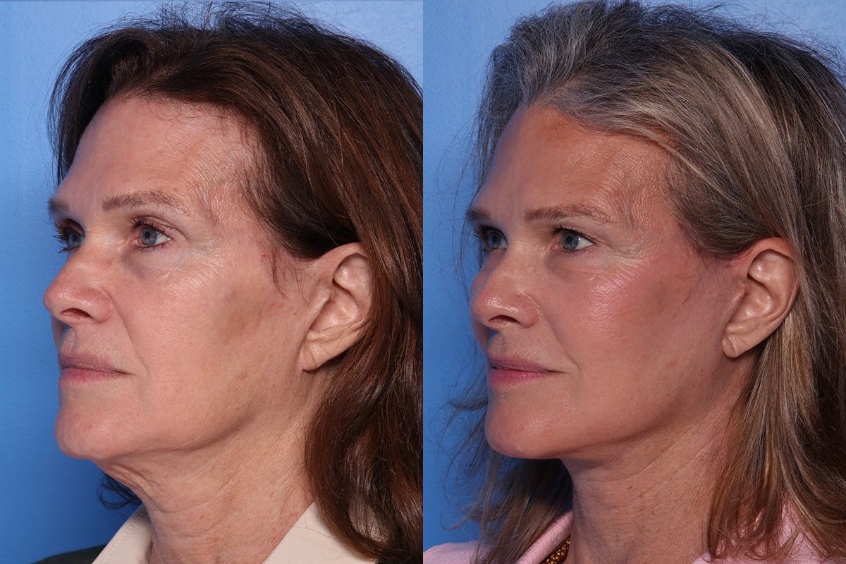 Facelift Before & After Gallery - Patient 342541 - Image 4
