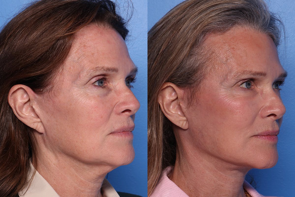 Facelift Before & After Gallery - Patient 342541 - Image 2